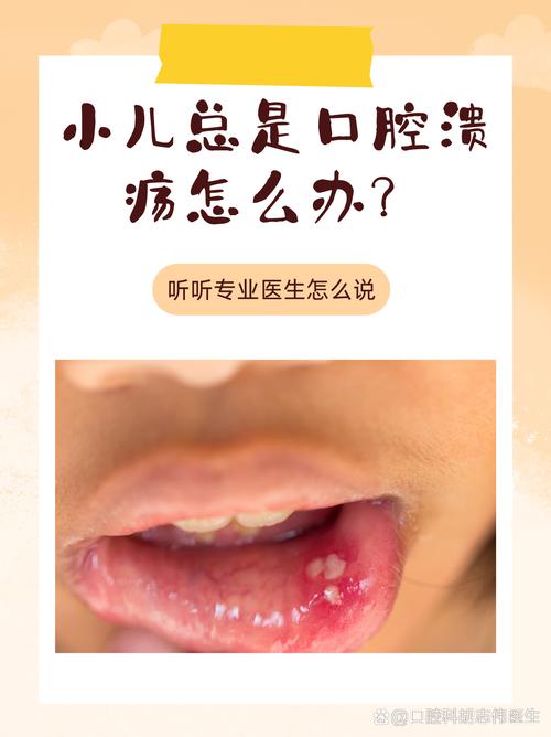 七个月宝宝口腔溃疡怎么办?