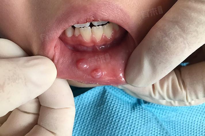 腮帮子小肉粒是啥?要紧吗?