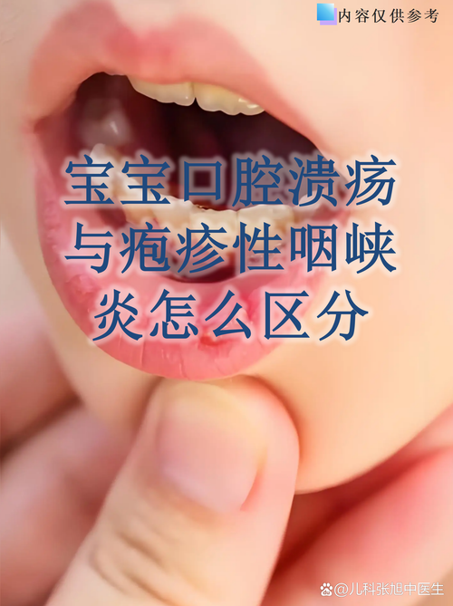 4个月宝宝口腔溃疡怎么办