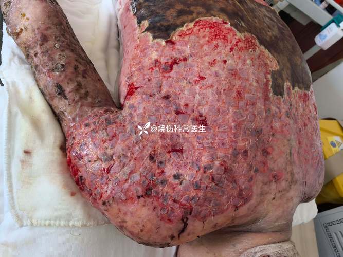 金葡菌性烫伤样皮肤综合征是何病?