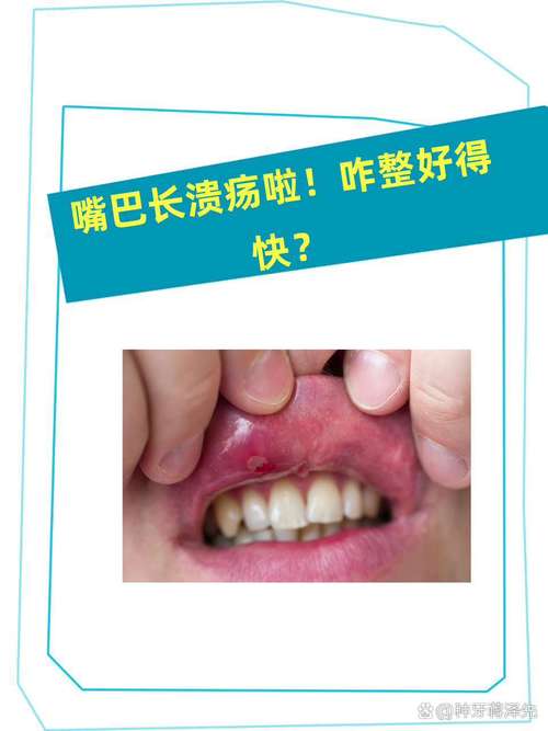 长了一嘴的口腔溃疡怎么办