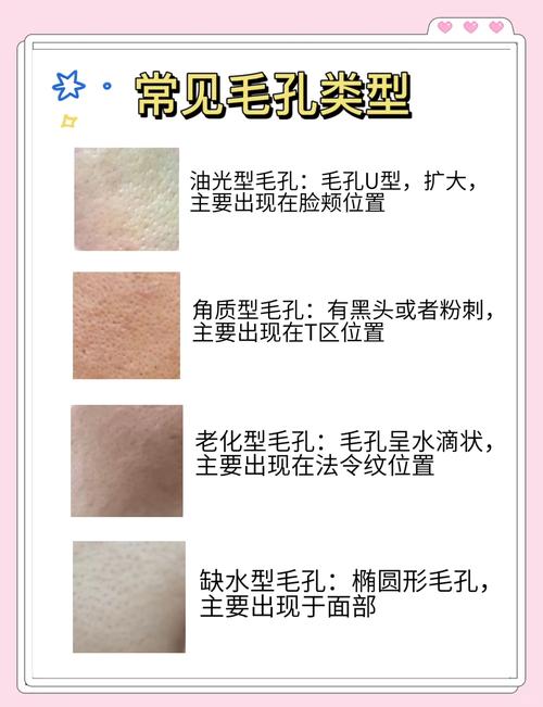 皮肤爱出油毛孔粗大怎么办