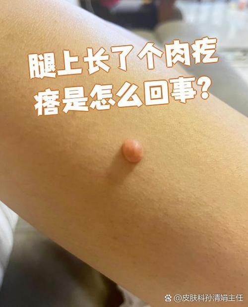 皮肤上长小肉疙瘩怎么回事