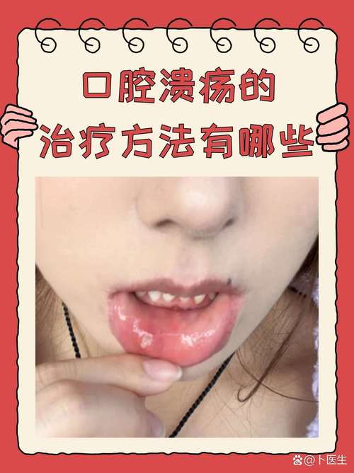口腔溃疡怎么快速好?舌头溃疡怎么治?