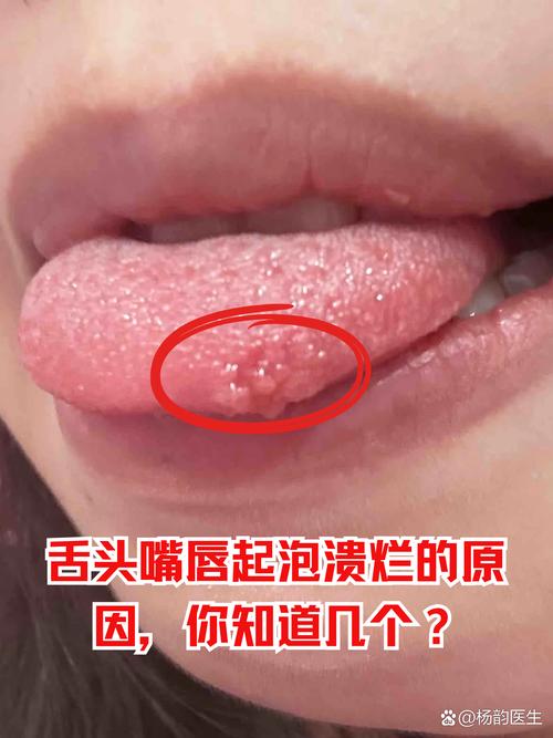 口腔溃疡怎么快速好?舌头溃疡怎么治?