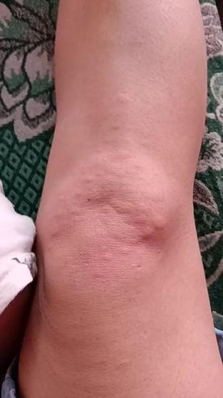 膝盖以下皮肤痒是怎么回事