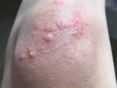 膝盖以下皮肤痒是怎么回事