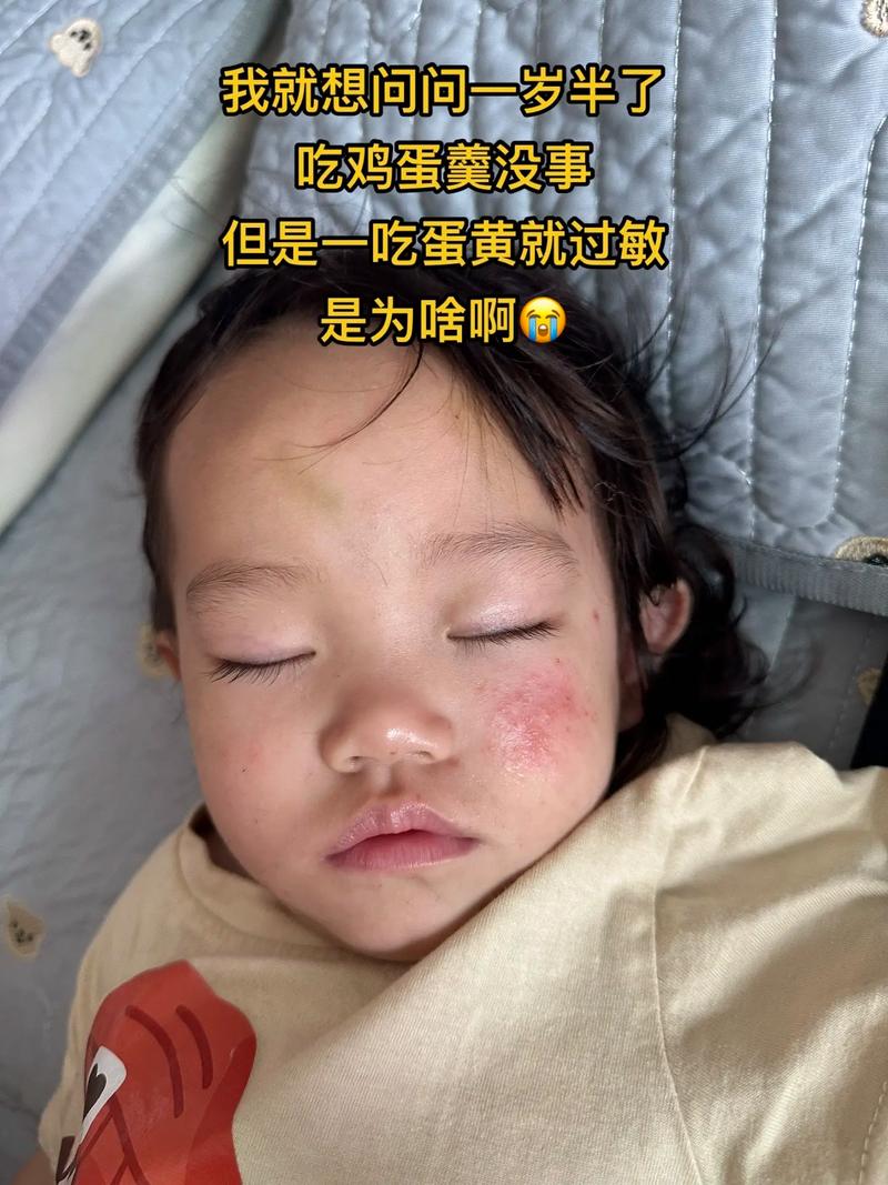 宝宝皮肤过敏能吃鸡蛋吗?