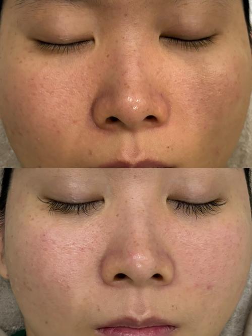 果酸换肤真能根治鸡皮肤吗?