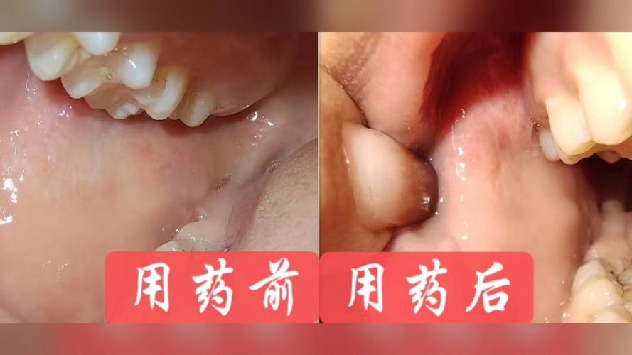 中医祖传方真能根治口腔扁平苔藓吗?