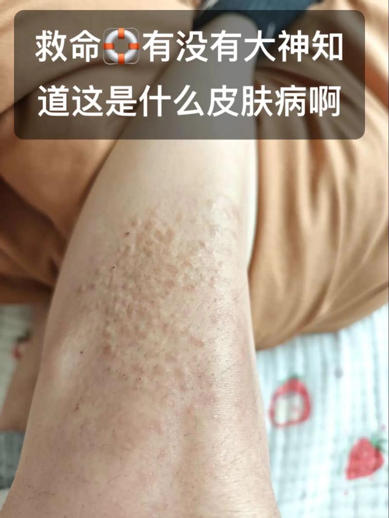 双下肢瘙痒,是皮肤病还是内科病?