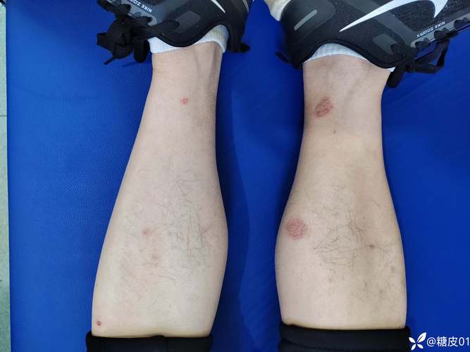 双下肢瘙痒,是皮肤病还是内科病?