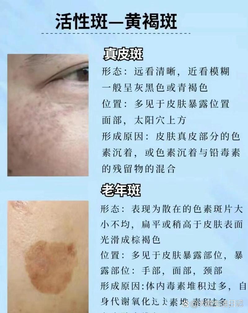 皮肤长斑背后,藏着哪些健康密码?