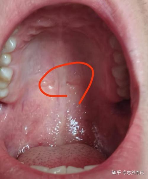 上颚疼,是口腔问题还是其他原因?