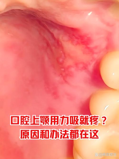 上颚疼,是口腔问题还是其他原因?
