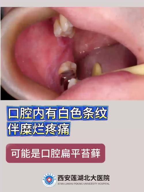 口腔内壁白斑是何原因?