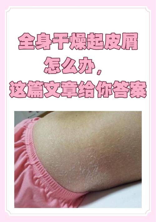 全身皮肤干燥掉皮屑,如何快速缓解?