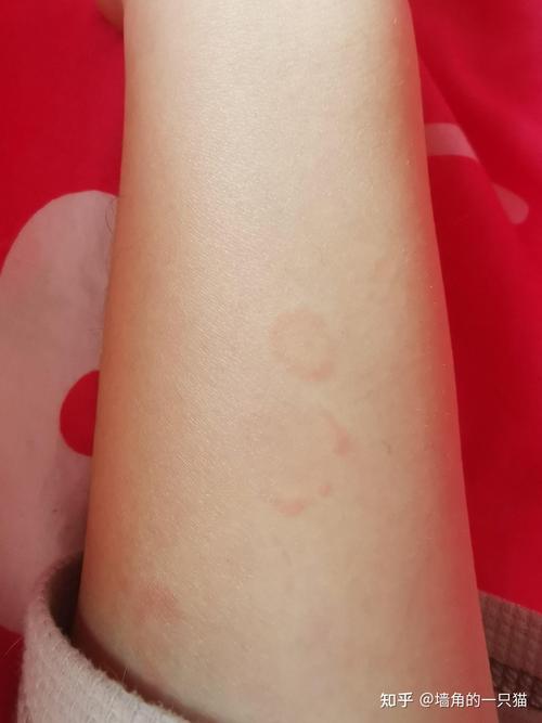 皮肤上长圆圈癣是啥病?咋治?