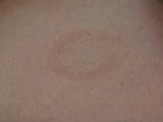 皮肤上长圆圈癣是啥病?咋治?