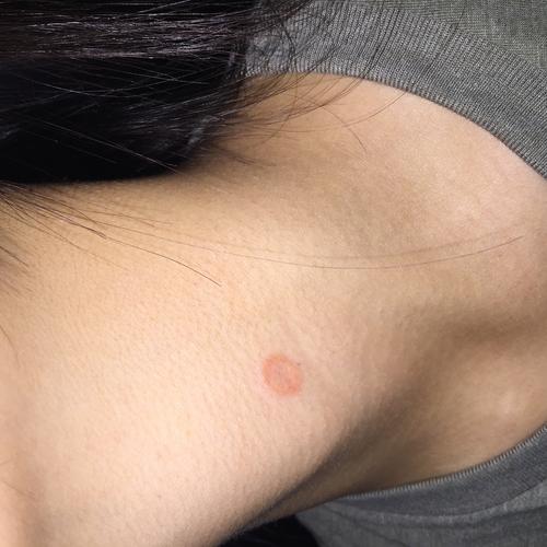 皮肤上长圆圈癣是啥病?咋治?