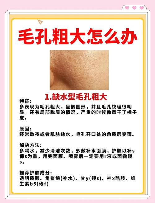 油皮毛孔粗大怎么改善?