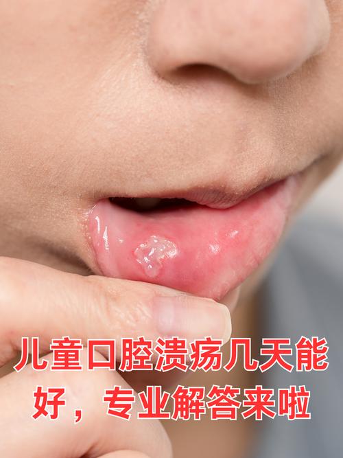 孩子口腔溃疡频发,如何有效应对?