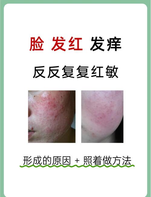 脸上过敏红肿,怎么快速缓解?