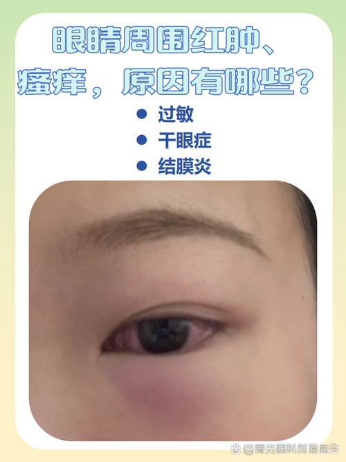 眼睛周围皮肤过敏怎么快速缓解?