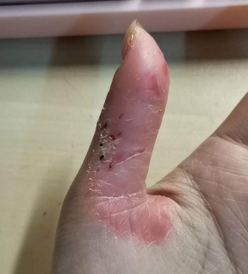 强迫性皮肤剥离症是种什么病?