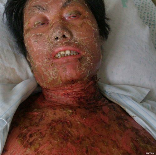 强迫性皮肤剥离症是种什么病?