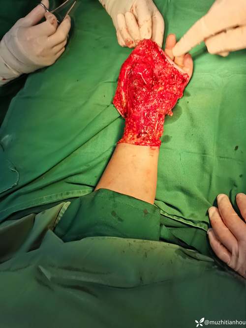 强迫性皮肤剥离症是种什么病?