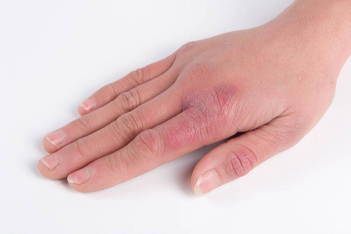 湿疹图片长啥样?症状表现有哪些?