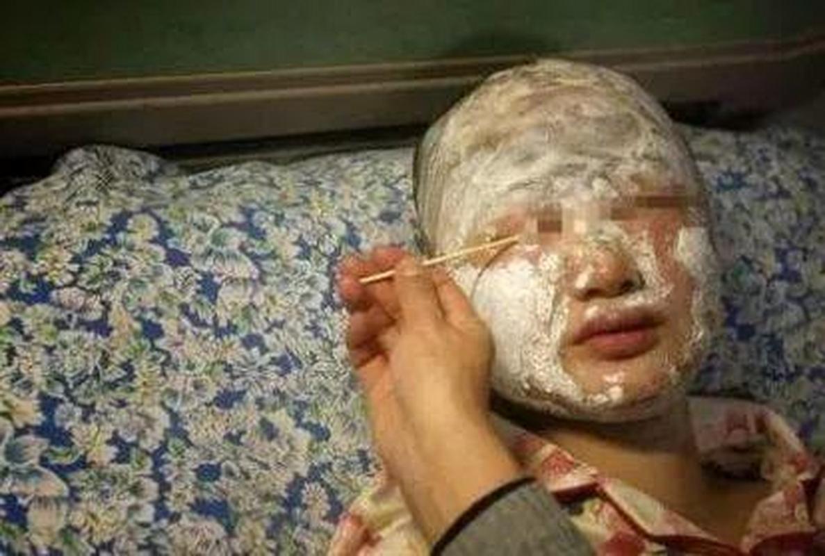 浓硫酸滴皮肤后该如何紧急处理?