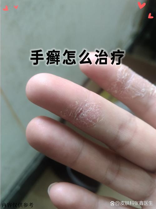 皮肤真菌感染如何快速有效治疗?
