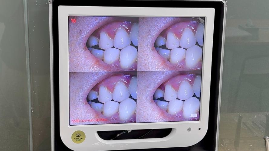 口腔内窥镜具体能查哪些口腔问题?