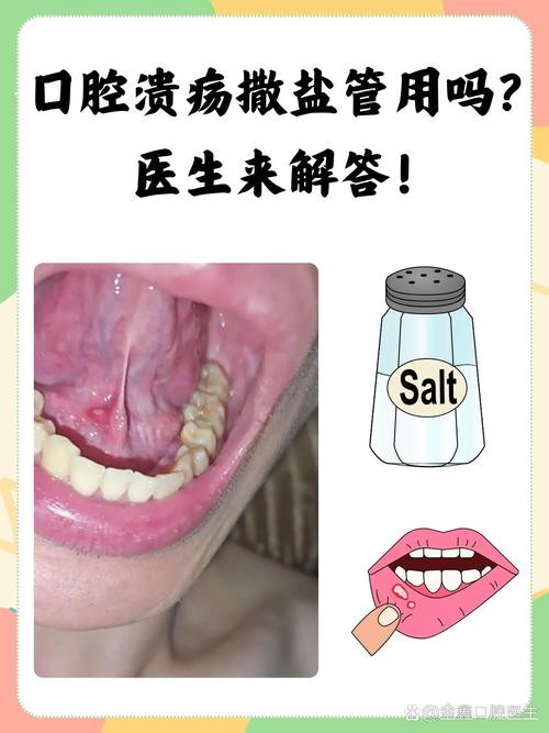 口腔溃疡为何总犯?如何快速好得快?