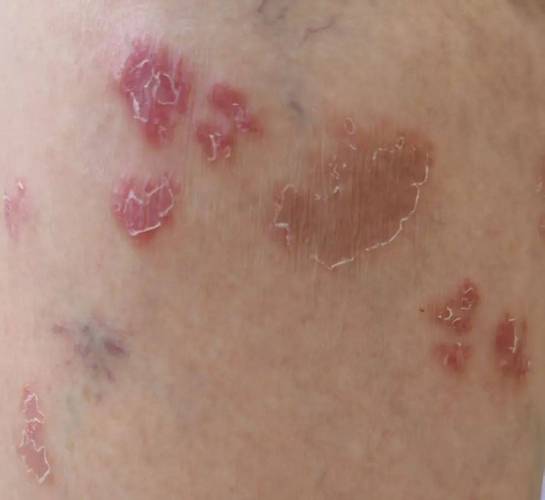 真菌感染初期图片长啥样?