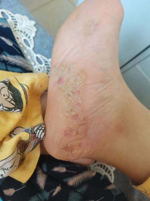 真菌感染初期图片长啥样?