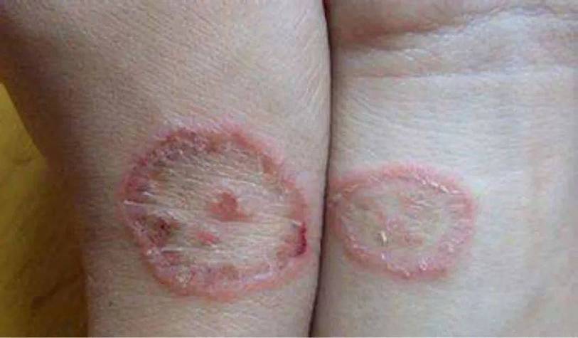 真菌感染初期图片长啥样?