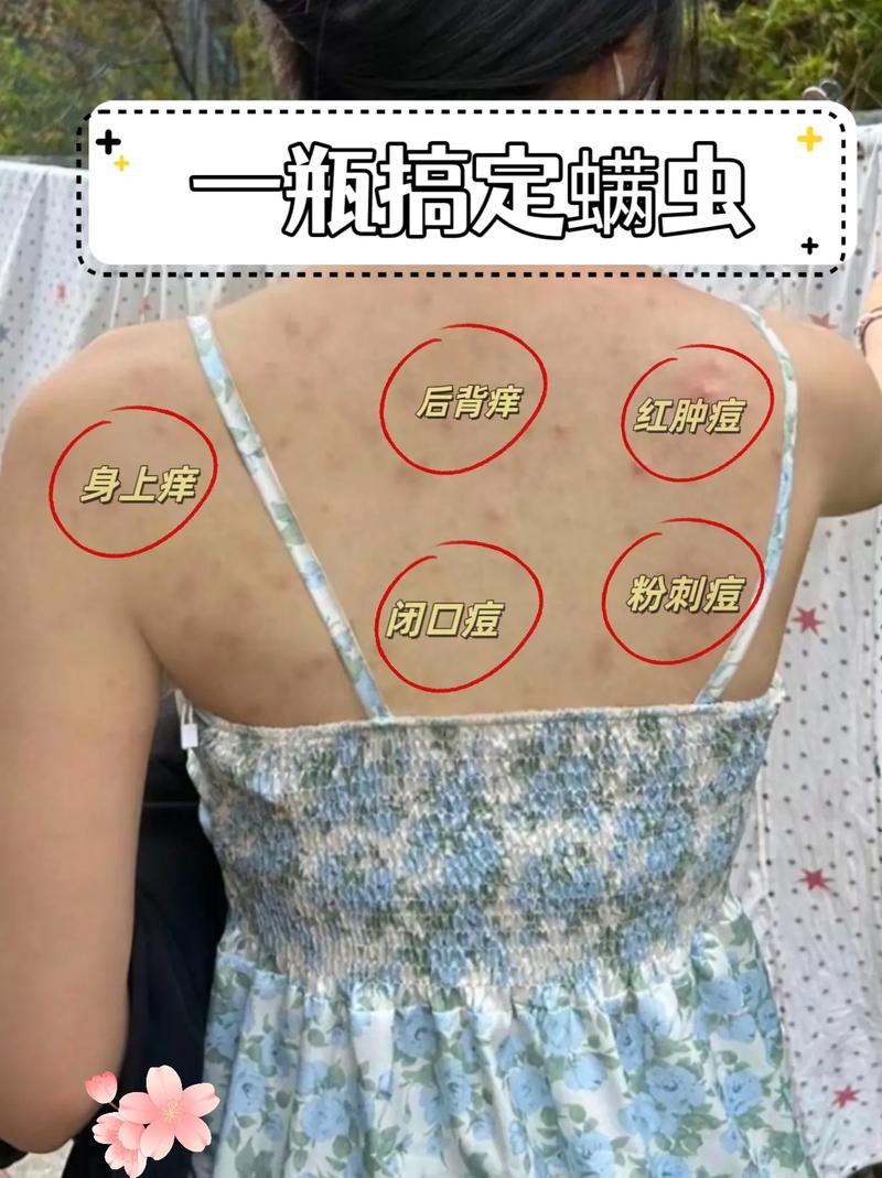 感染螨虫的皮肤怎么治?