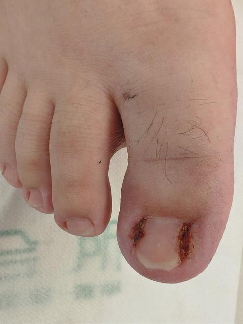 甲沟炎该挂外科还是皮肤科?