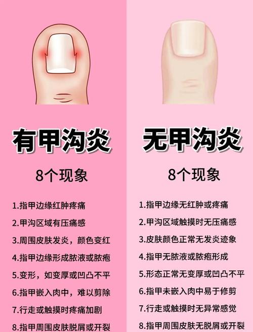 甲沟炎该挂外科还是皮肤科?