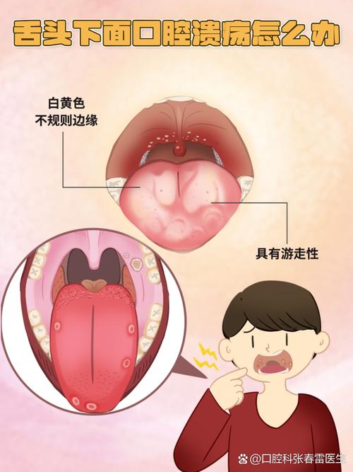 舌下口腔溃疡是何原因引发?