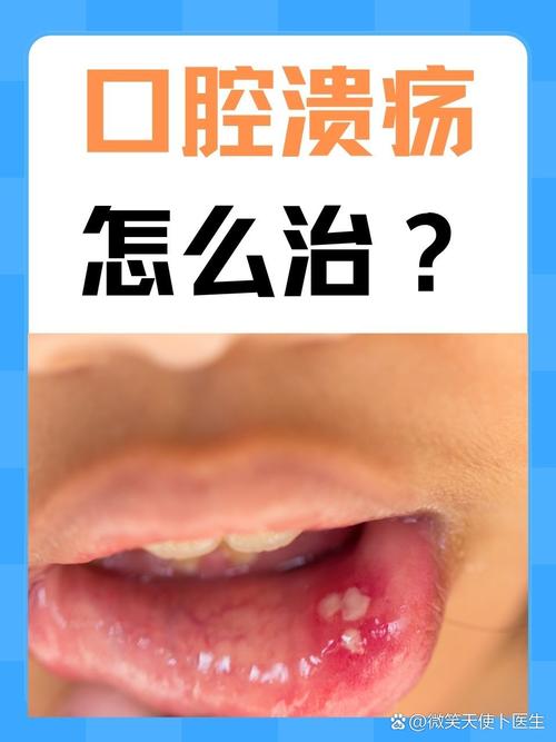 口腔溃疡缺维生素c还是b