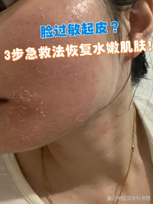 化妆品过敏了,这5步紧急处理你做对了吗?