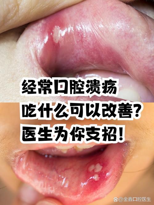 口腔溃疡吃维生素B2有用吗?