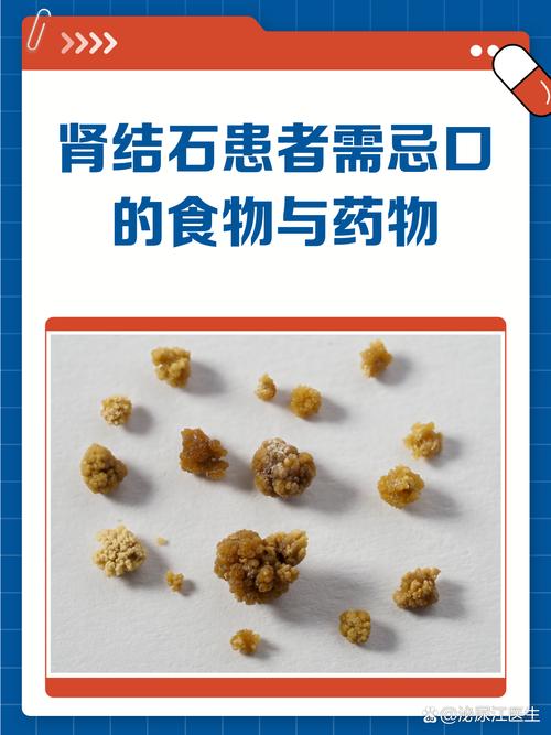 肾结石患者哪些食物绝对不能吃?