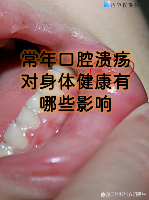 口腔溃疡为何总不好?