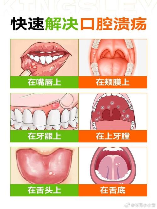 口腔溃疡总不好是什么原因