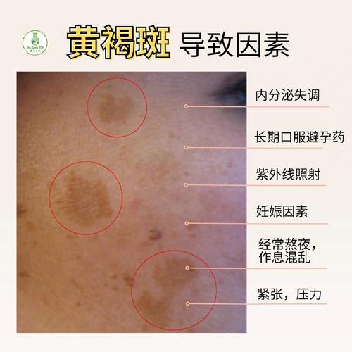 皮肤有黑色素沉淀怎么办